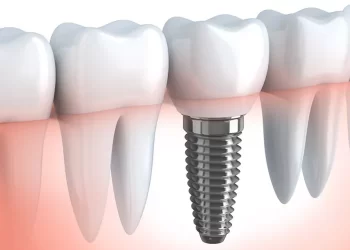اسعار زراعة الاسنان في الكويت