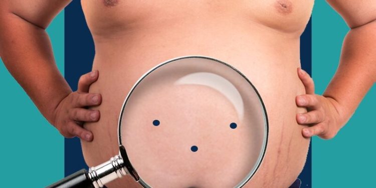 النظام الغذائي بعد عمليات تصغير المعدة